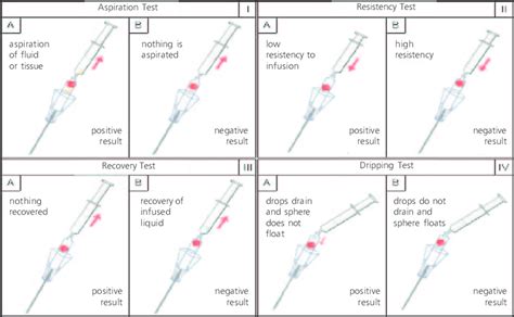 saline drop test definition|veress needle vs hasson.